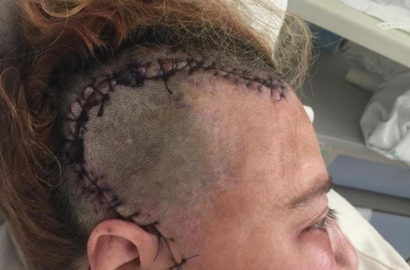 Acquaviva, ha un tumore al cervello incurabile: Conny salvata da medico del Miulli