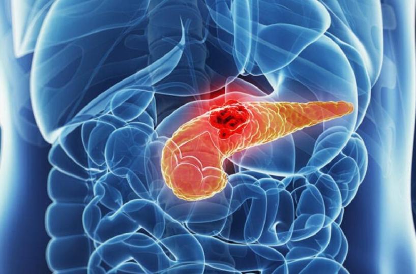 Tumore al pancreas, studio Uniba su farmaci per superare chemioresistenza
