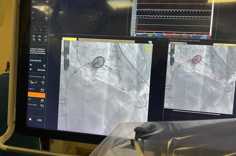 Bari, l'intervento al cuore è troppo rischioso: procedura ibrida su 82enne per sostituire valvola mitralica: è la prima volta in Italia
