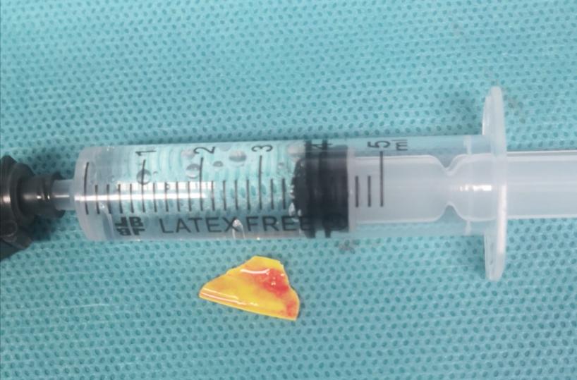 Ingoia scheggia di plastica: bimba di 14 anni salvata a Bari senza tracheotomia