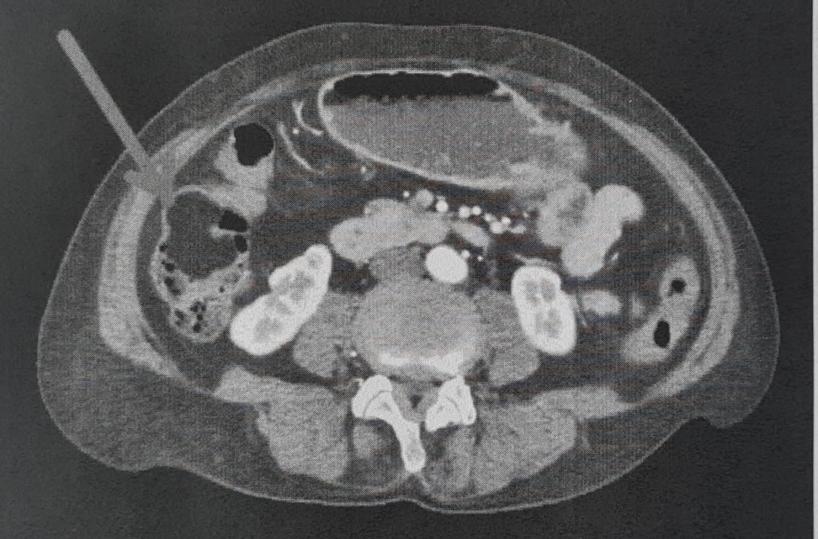 Corato, va in ospedale per un mal di pancia e le scoprono un grosso tumore benigno al colon