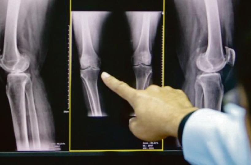 Osteoporosi, quando le ossa cedono