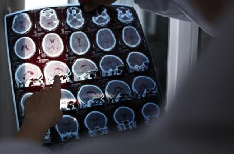 Nuove molecole e bersagli, così si evolve la terapia contro l'Alzheimer: il punto