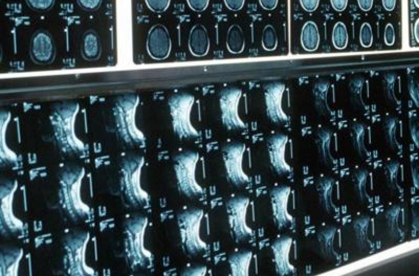 Ipofosfatemia legata all'X, primo bilancio e prospettive su linee guida