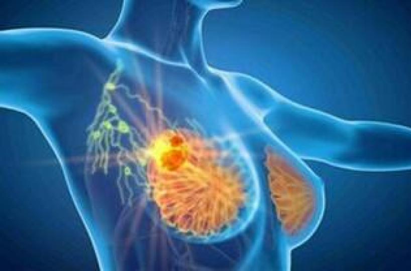 Cancro seno iniziale Her2+, con anticorpo farmaco-coniugato -53% recidiva