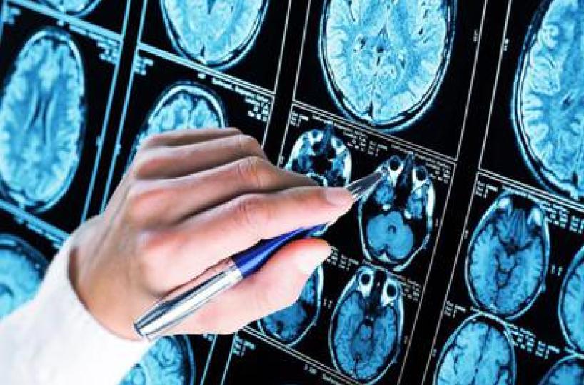 Alzheimer, 300mila euro a 6 scienziati per diagnosi precoce e prevenzione